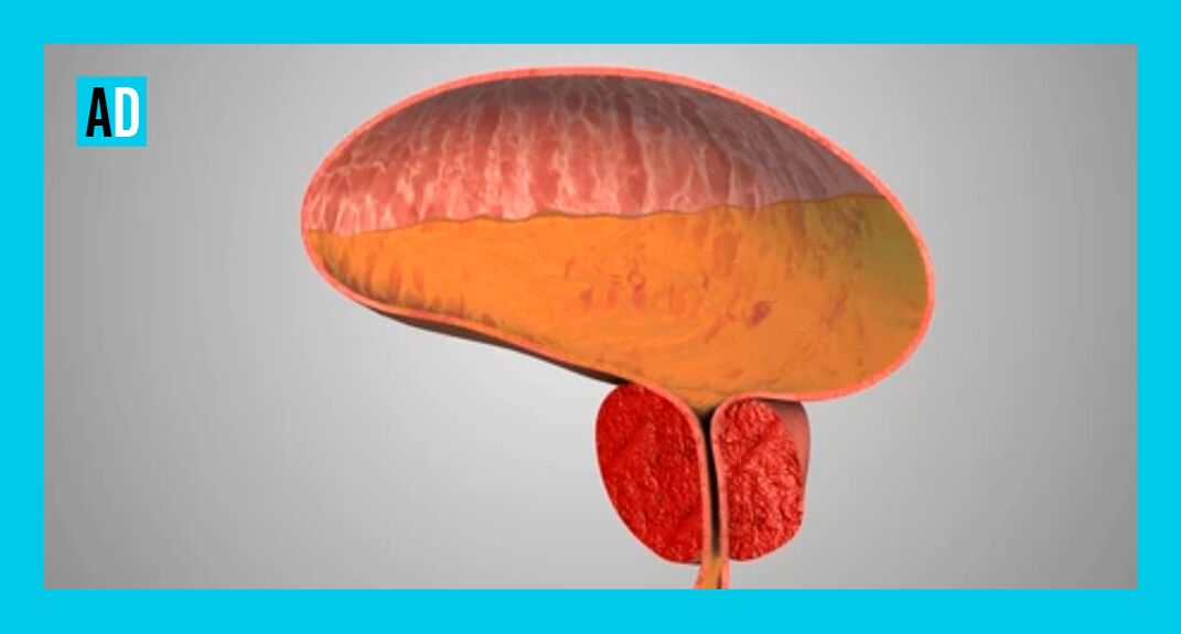 Ghiandola prostatica infiammata